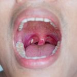 Tonsil,stone,in,the,mouth
