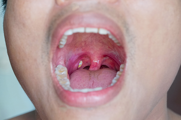 Tonsil,stone,in,the,mouth