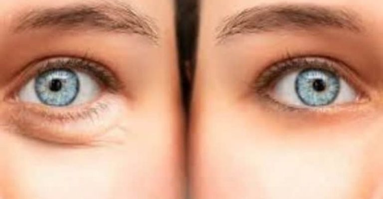 Panduan Lengkap Cara Mengurangi Kantung Mata Secara Permanen Untuk Penampilan Lebih Segar